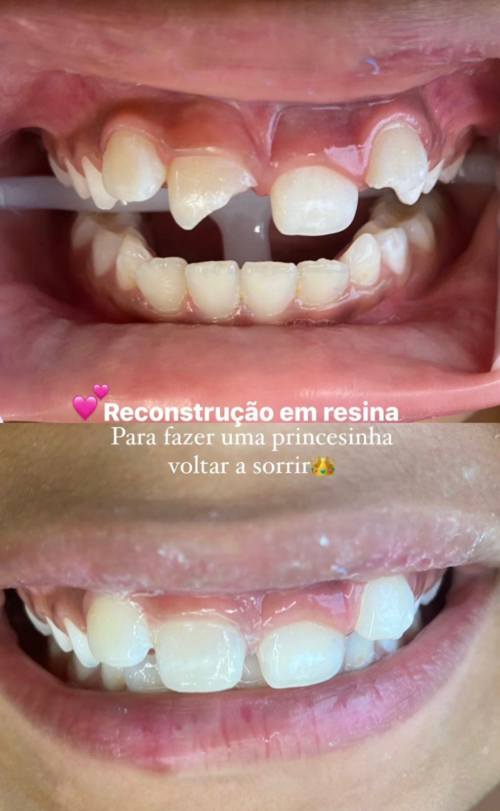 Reconstrução Dental com Resina Premium